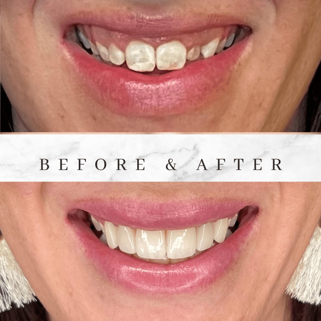 Smile transformation showing teeth before and after cosmetic dentistry.