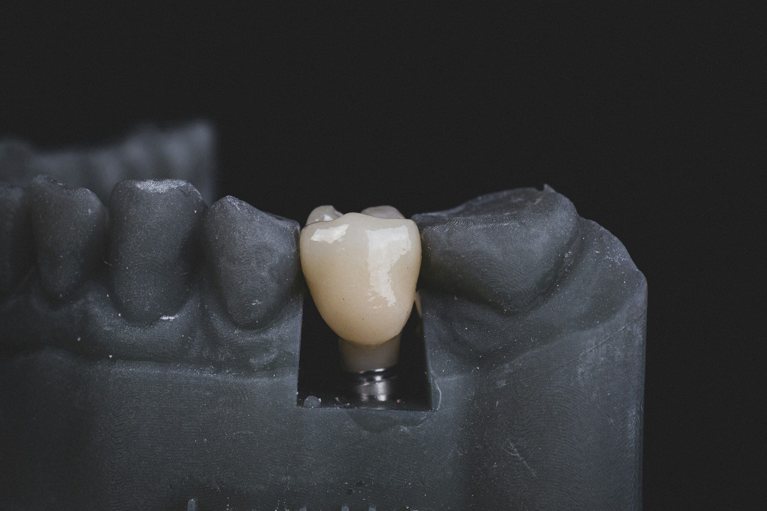 Dental implant model showing the structure of a replacement tooth.
